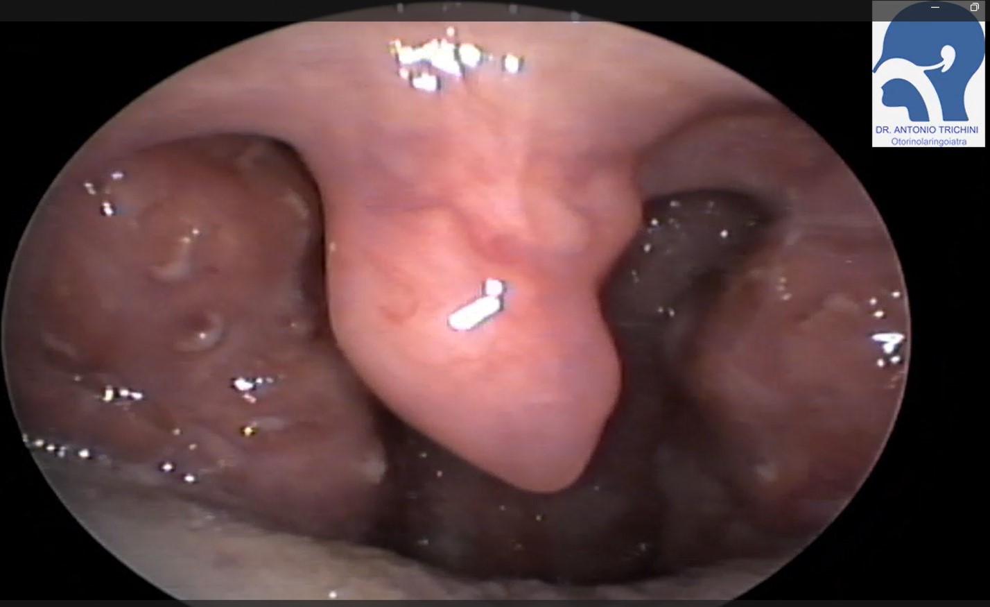 Le Tonsille palatine criptiche: cause e trattamento